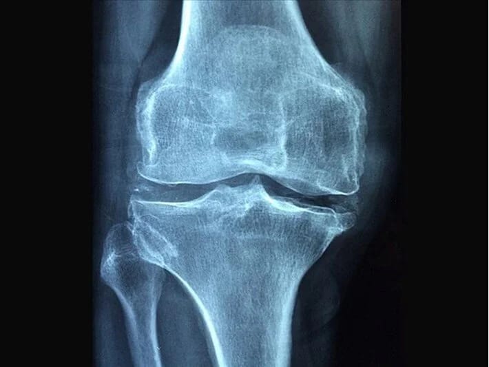 Sınıq sümüklərdə əməliyyatsız sağalma ümidi