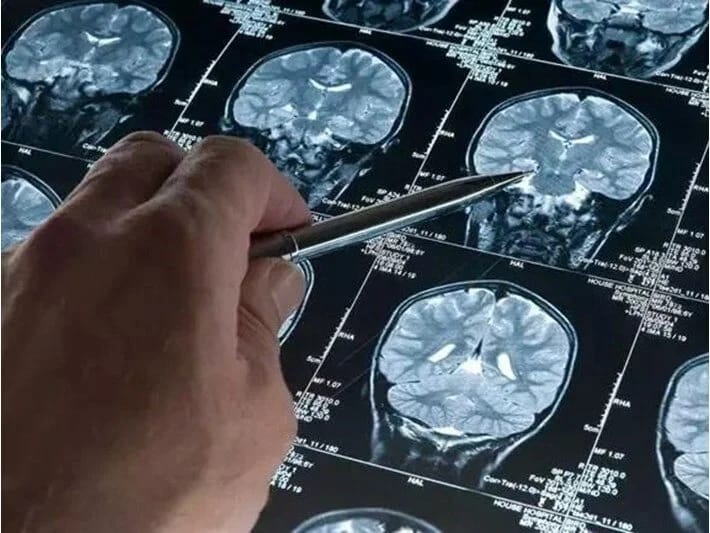 Qan testi Alzheimer diaqnozu üçün inqilab yarada bilər