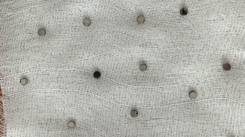 Türkiyədə 3 yaşlı uşaq 19 ədəd maqnit udub