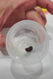 Bakıda körpənin ağciyərindən lobya toxumu çıxarılıb