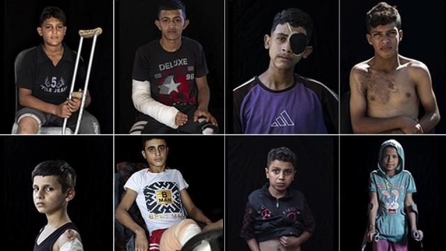 Qəzzada 5 mindən çox uşaq amputasiya edilib