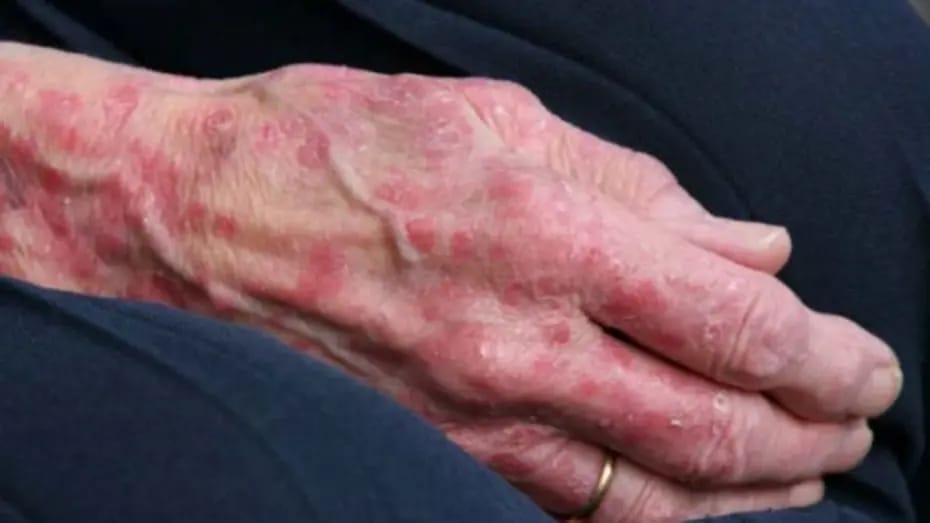 Rumıniya və Xorvatiyada cüzəm halları qeydə alınıb: 40 ildən sonra ilk hadisə