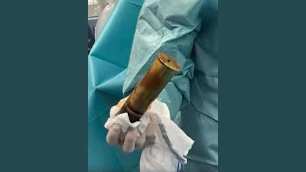 24 yaşlı oğlanın düz bağırsağından Birinci Dünya Müharibəsindən qalma top mərmisi çıxarılıb