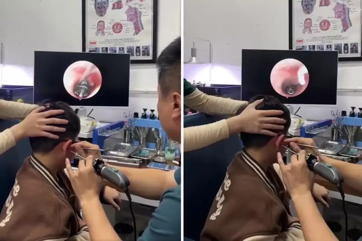 Balaca uşağın qulağından vint çıxdı