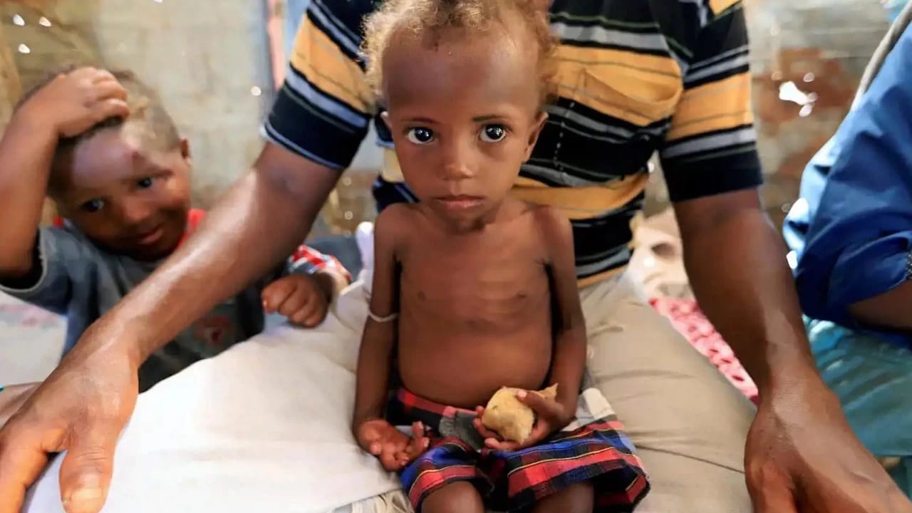 Yəməndə qızılca epidemiyası: 36 uşaq ölüb