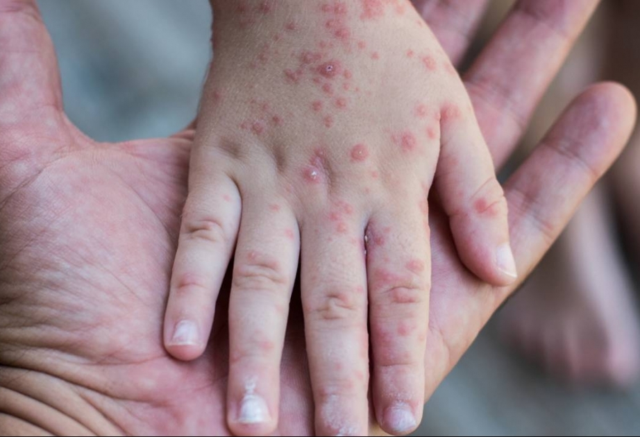 ÜST-dən xəbərdarlıq - bu xəstəliyə yoluxma yenidən artmağa başlayıb