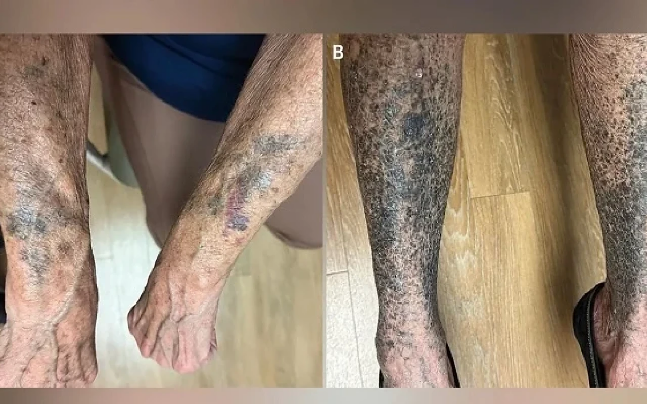 Antibiotik qəbul edən qadın görün nə hala DÜŞDÜ