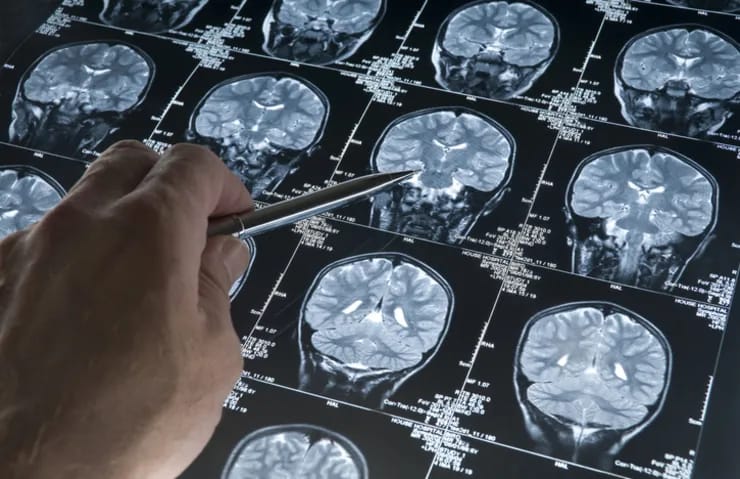 Alzheimer tədqiqatında təəccüblü irəliləyiş! Həll misdə ola bilər
