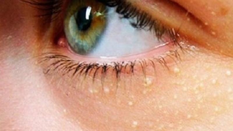 Üzdəki sarı ləkələr ürək tutması və insult riskindən xəbər verir