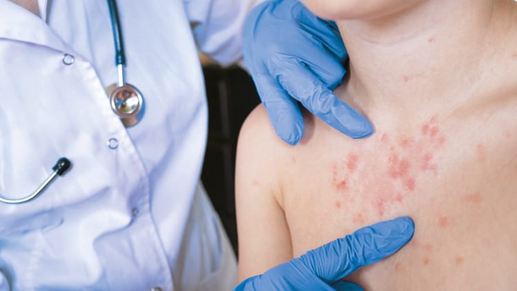 ABŞ-da qızılca epidemiyası ilə bağlı xəbərdarlıq