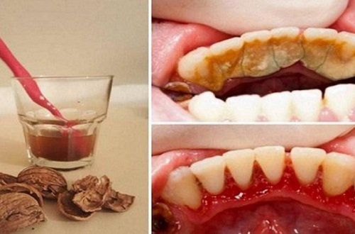 Diş daşlarını aradan qaldıran möcüzəvi