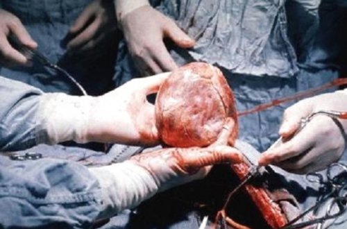 Ürəyindən 4 sm uzunluğunda iynə çıxarıldı