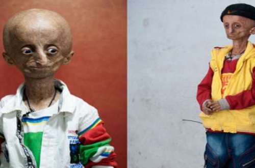 15 yaşlı uşaq vaxtından əvvəl qocalıb