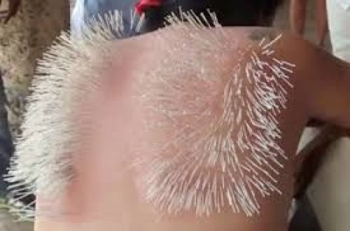 Bədəninə minlərlə iynə batırdı
