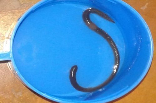 Məktəblinin mədəsində 18 santimetrlik soxulcan çıxdı