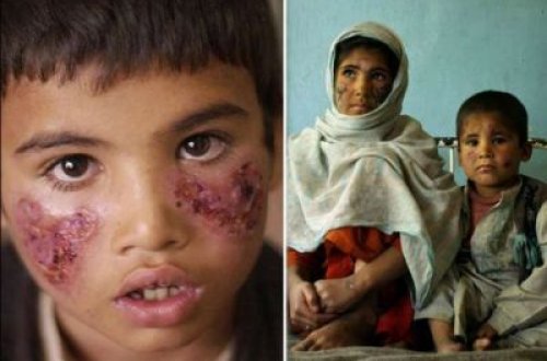 İŞİD dəhşətli virus yayır