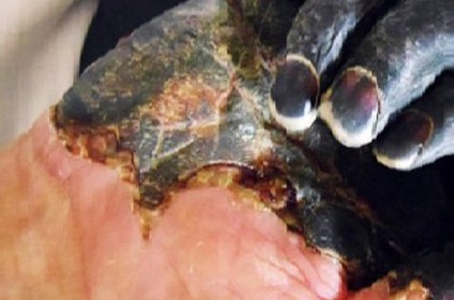 Şərqdə yeni qorxulu xəstəlik yayılır