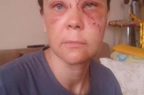 Bakıda Qadının başı eskalatora çırpıldı, üzü pis hala düşdü