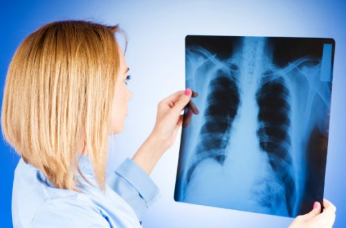 Son 25 il ərzində vərəmdən ölüm halları iki dəfə azalıb