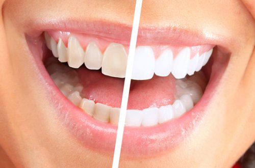 Dişlərinizi ağappaq etmək hələ belə asan olmamışdı