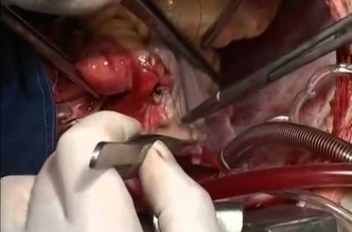 Cərrahlar ürəyin transplantasiya anlarını kameraya çəkiblər