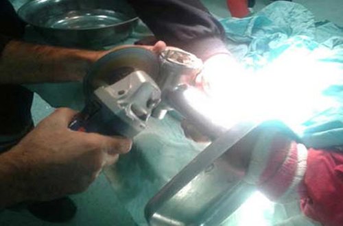 3 yaşlı uşağın əli ət maşınında qalıb