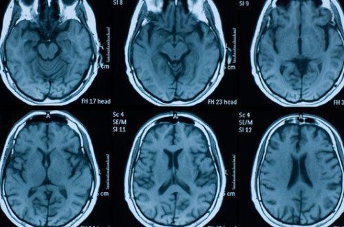 Cinsini dəyişən gəncin beyni həkimləri təəccübləndirdi