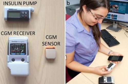 Smartfonla işləyən ilk süni mədəaltı vəz