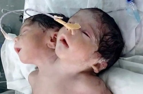 Hindistanda iki başlı körpə doğuldu
