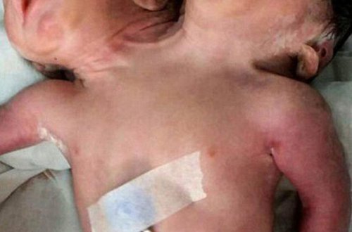 İkibaşlı uşaq doğuldu - VİDEO