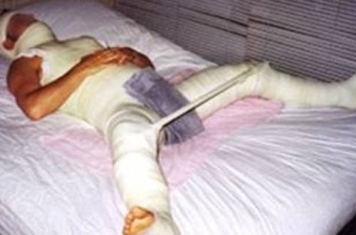 İntim münasibət zamanı cinsiyyət orqanı kökündən qırıldı