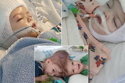 Başları bitişik əkizləri ayırdılar - Həkimlər yaşamayacaqlarını demişdilər...