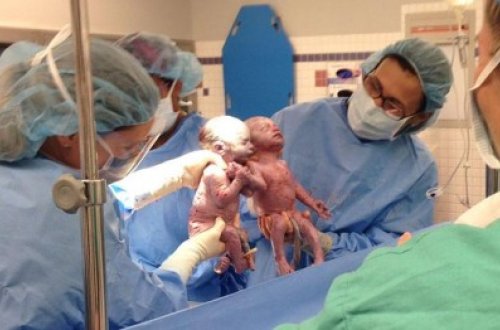 Dünyaya gələn əkizlərin hərəkəti həkimləri ağlatdı - Fotolar