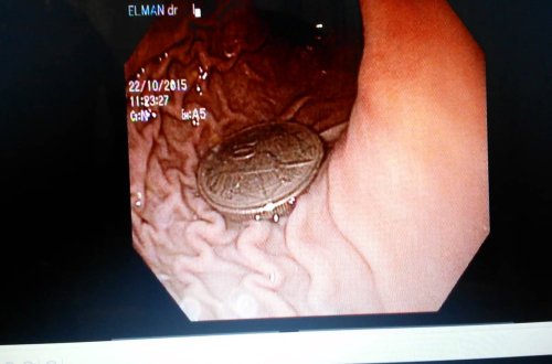 4 yaşlı uşağın mədəsindən `qəpik` çıxdı
