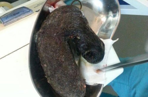 Qızın mədəsindən çıxanlar həkimləri HEYRƏTLƏNDİRDİ - BAKIDA - FOTO