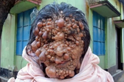 Həkim səhvi qadını BU HALA SALDI - FOTOLAR