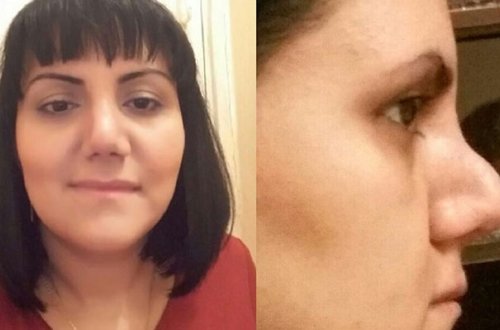 AVRASİYA HOSPİTALINDA BİABIRÇILIQ: Qadın burnunu əməliyyat elətdirdi, bu günə düşdü - ŞOK FOTO