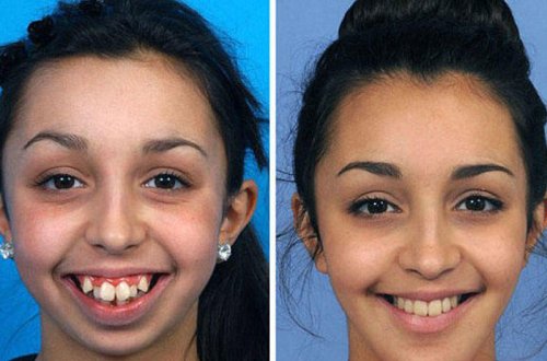 Bir vaxtlar üzündən utanan qız gözəllik kraliçası olacaq - FOTOLAR