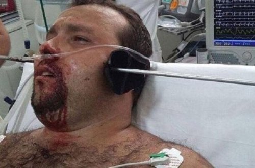 MÖCÜZƏ: Nizə başının bu tərəfindən girib o biri tərəfindən çıxdı, amma ölmədi - FOTO-VİDEO