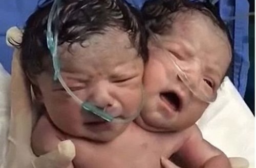 Bütün dünyanı şoka salan olay: İkibaşlı uşaq dünyaya gəldi – VİDEO