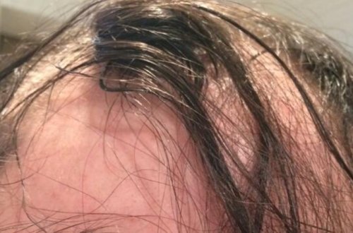 Saçınız tökülürsə, deməli bu xəstəliyiniz var – MÜTLƏQ OXUYUN!