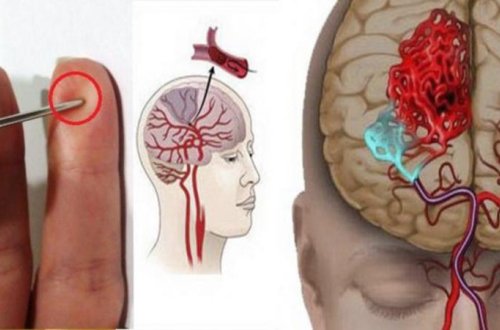 Adi iynə insult keçirən xəstənin həyatını xilas etdi - VİDEO