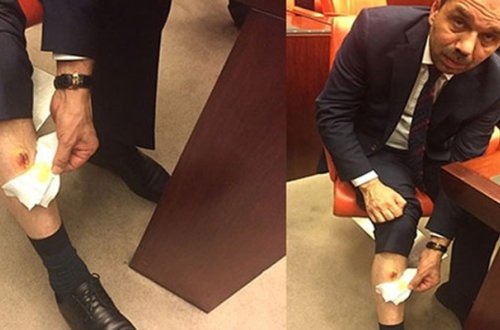 O davada deputatın ayağını da dişləyiblər - İstintaq başladı + Foto