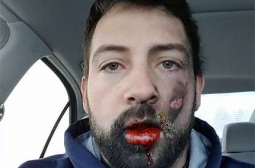 Elektron siqaret ağzında partladı, 7 dişini itirdi