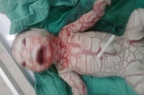 Türkiyədə hamilə qadın dünyaya ilan gətirdi - Əsəbi zəif olanlar izləməsin - VİDEO