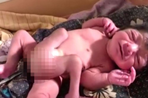 Dördayaqlı körpə doğuldu – FOTOLAR