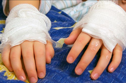 3 yaşlı qız süd qazanına düşərək yanıb