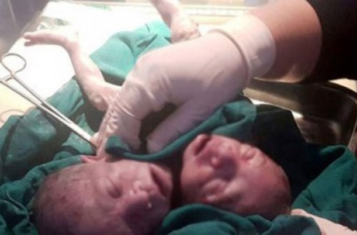 İki başlı uşaq dünyaya gəldi - Əkiz deyillər - FOTOLAR