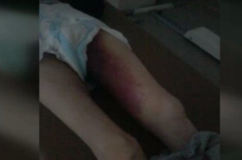 Bakıda xəstənin ayağı sındı — 1 Nömrəli Ruhi Dispanserdə nə baş verir?