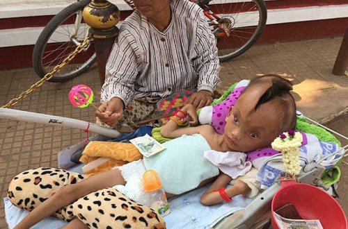 Zavallı uşaq: başındakı dəlik fasiləsiz böyüyür - VİDEO - FOTO